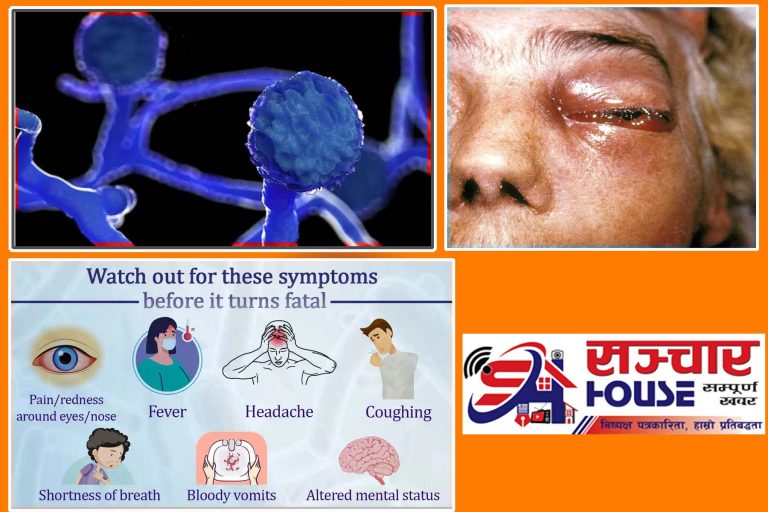 के हो कालो ढुसी ? लक्षण कस्तो हुन्छ ? कसरी बच्न सकिन्छ ? र नेपालमा यसकाे अवस्था कस्तो छ ?